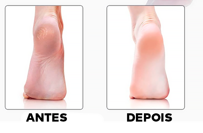 Esfoliador Removedor Elétrico para Calos e Rachaduras - ®Max Pedicure