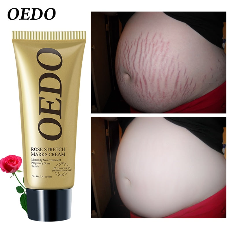 Creme Para Remoção de Estrias - ®OEDO BEAUTY