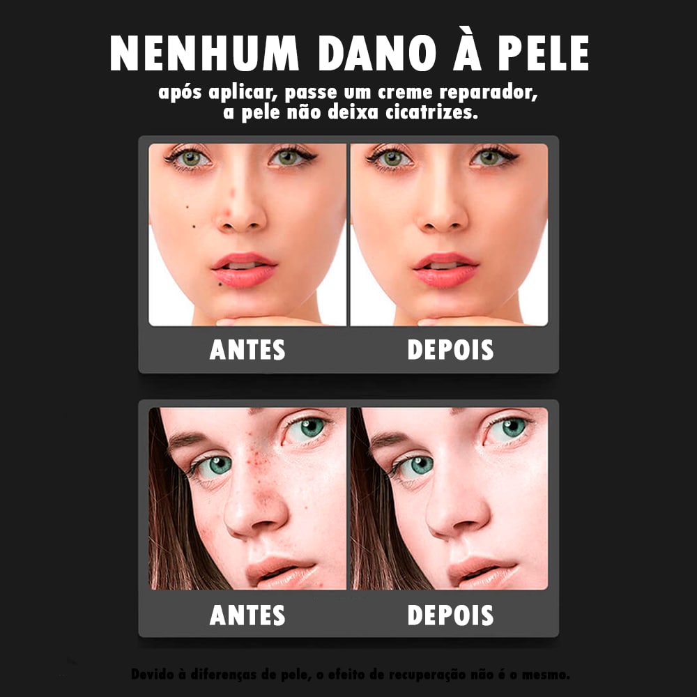 Caneta Laser Plasma 9 em 1 Removedora de manchas, verrugas, sardas e tatuagem ®PenPlasma