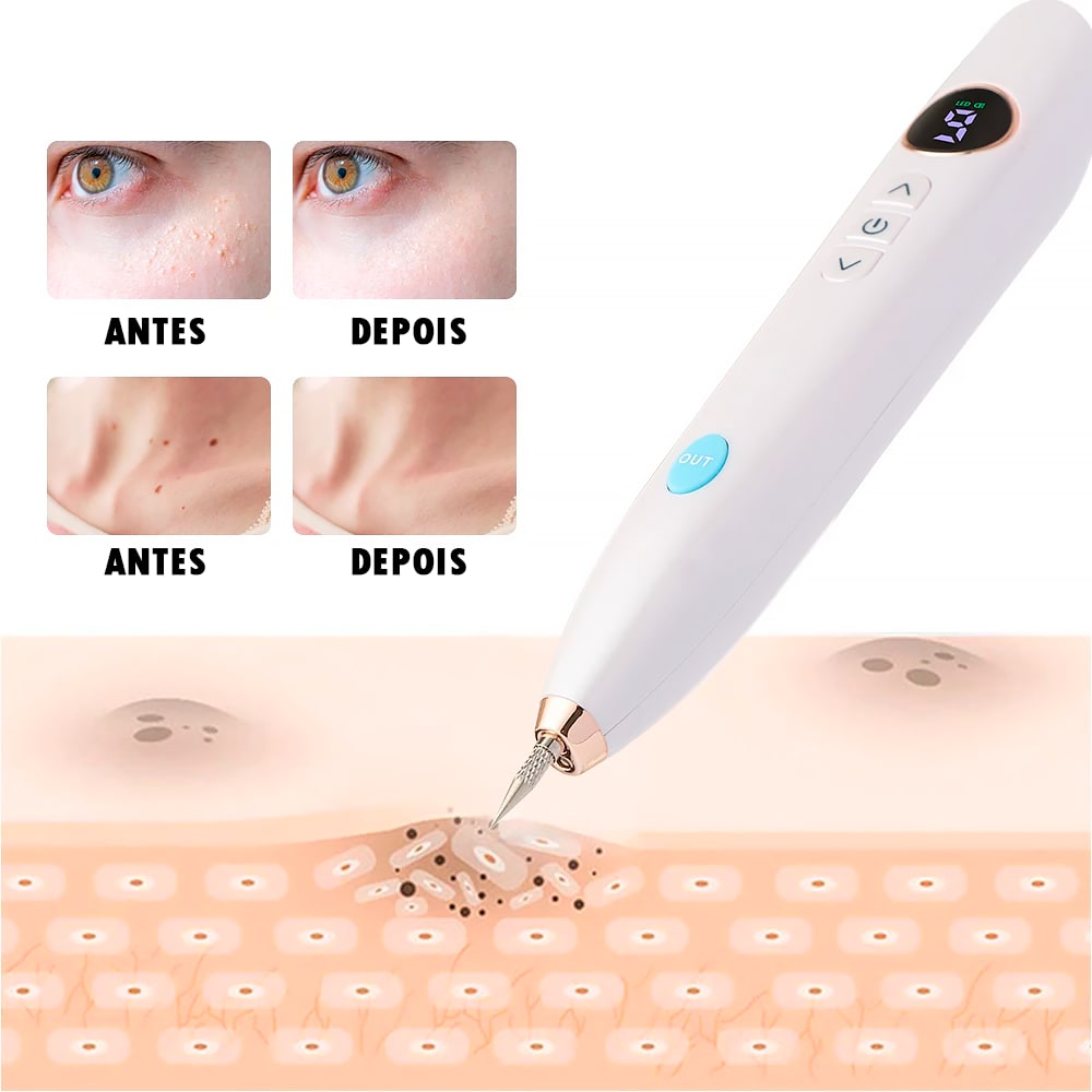 Caneta Laser Plasma 9 em 1 Removedora de manchas, verrugas, sardas e tatuagem ®PenPlasma