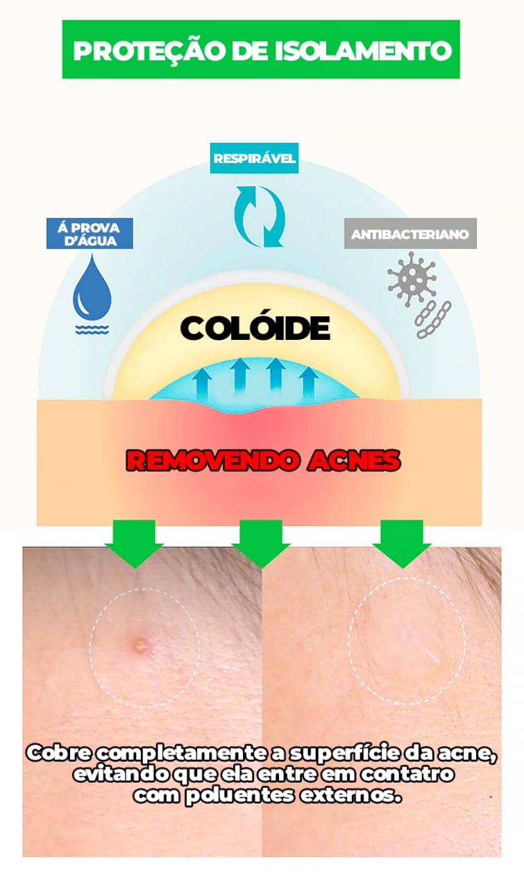 Adesivo Secador e Clareador de Espinha 36/144 Peças - SKIN PATCH®