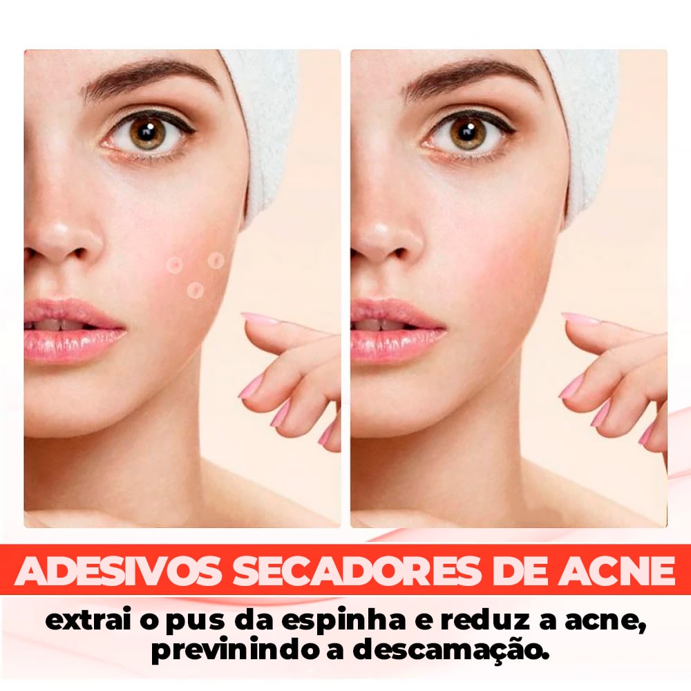 Adesivo Secador e Clareador de Espinha 36/144 Peças - SKIN PATCH®