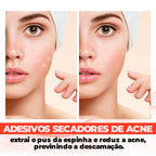 Adesivo Secador e Clareador de Espinha 36/144 Peças - SKIN PATCH®