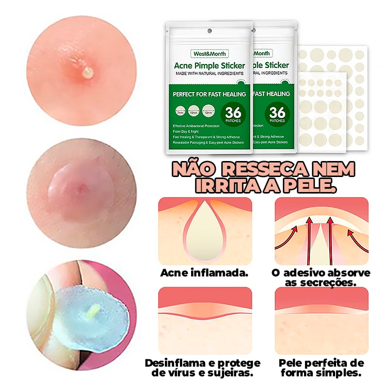 Adesivo Secador e Clareador de Espinha 36/144 Peças - SKIN PATCH®