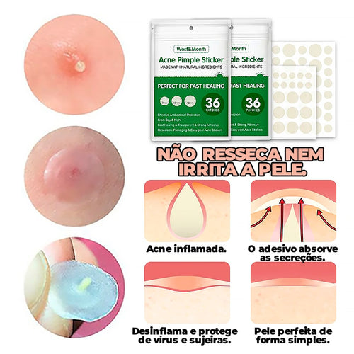Adesivo Secador e Clareador de Espinha 36/144 Peças - SKIN PATCH®