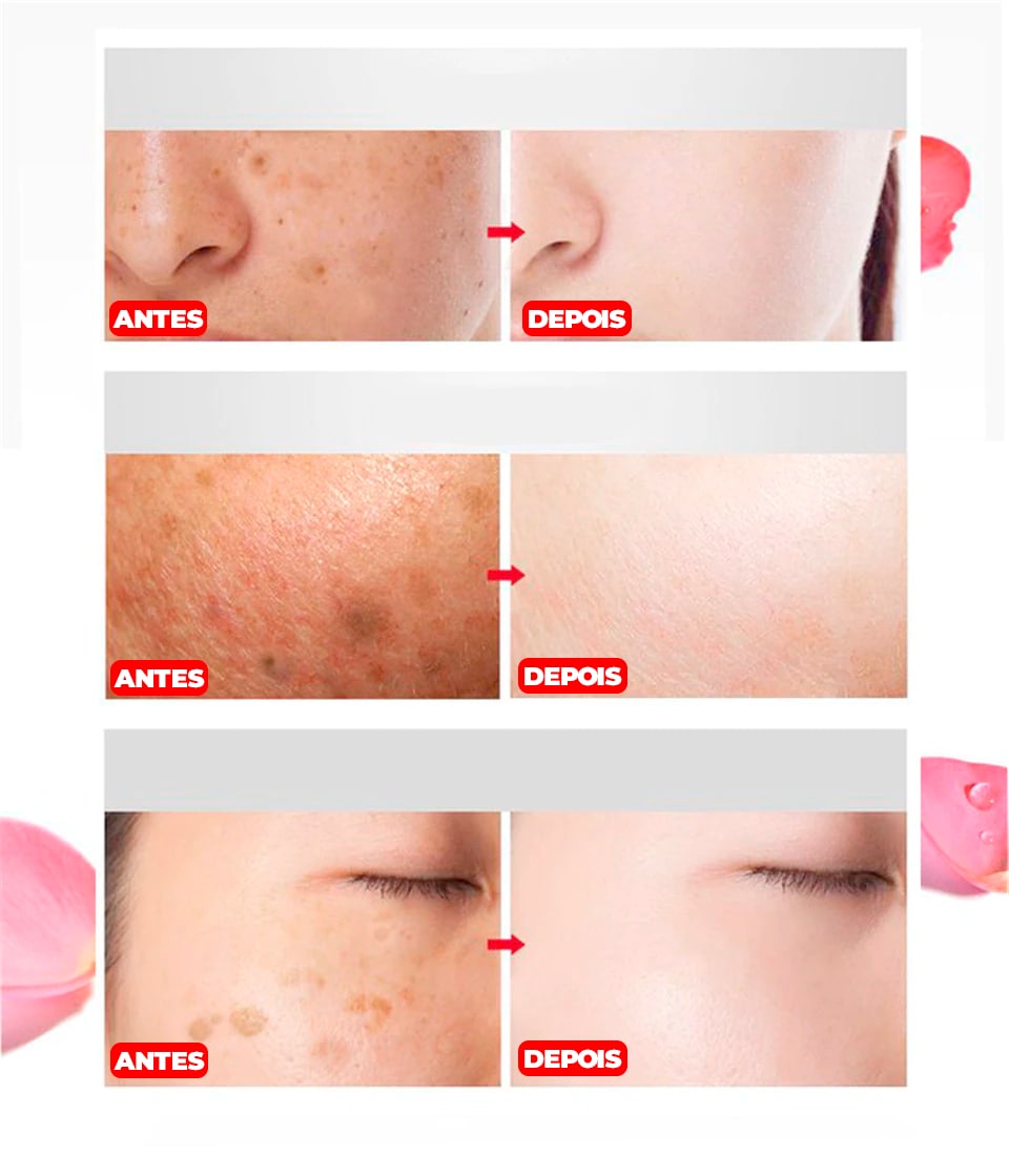 Creme Removedor de Manchas -®PinkBeauty