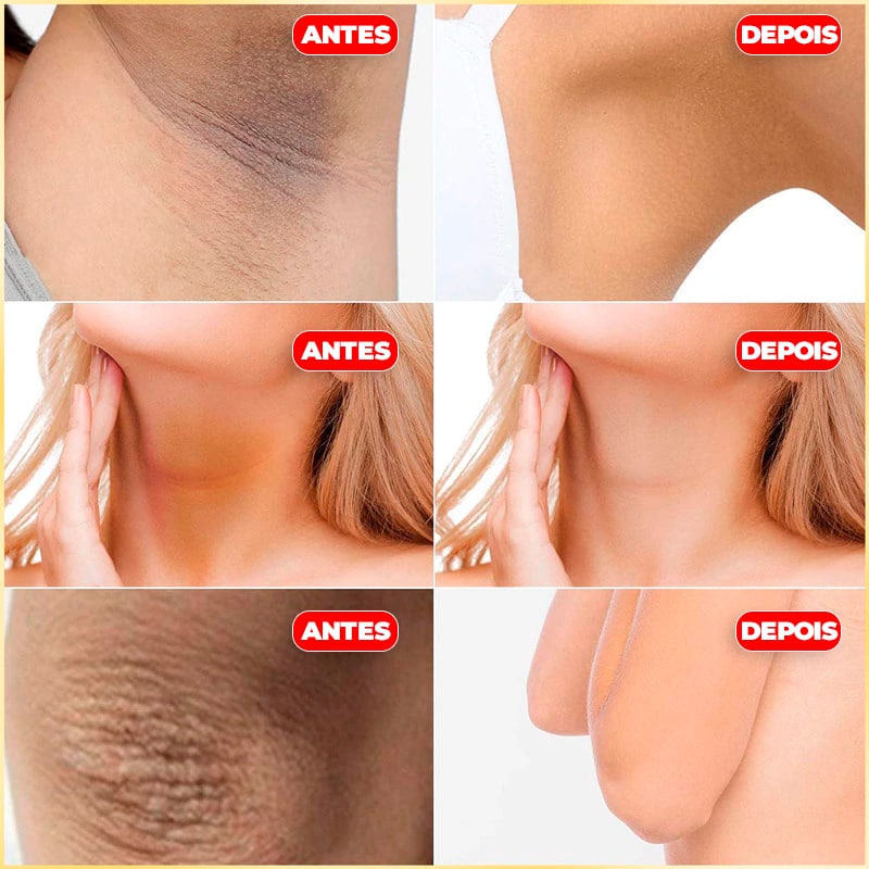 Creme Clareador de Axilas, Virilha, Pescoço e Cotovelo - Retinol®