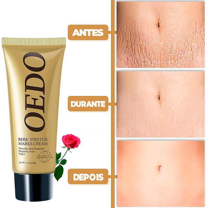 Creme Para Remoção de Estrias - ®OEDO BEAUTY
