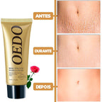 Creme Para Remoção de Estrias - ®OEDO BEAUTY